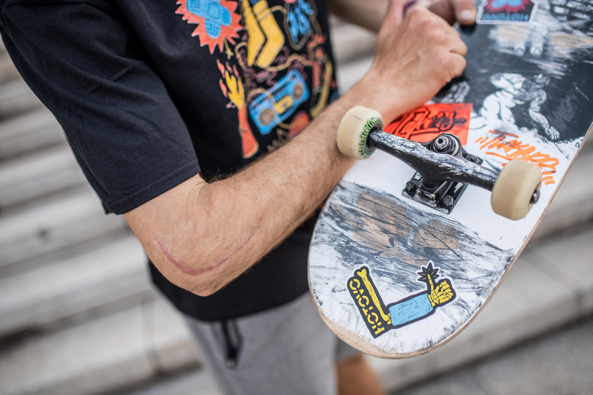 riso tury broken elbow